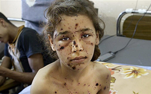 A 9-year-old girl is covered in shrapnel wounds at Al Shifa hospital in Gaza City Photo: Rex